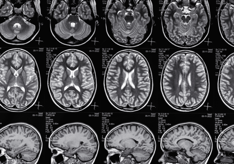 Marathon Law Group Brain Injury